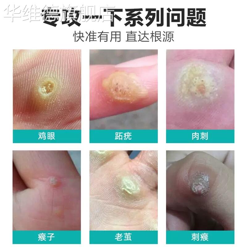 鸡眼贴膏药鸡贴眼跖疣肉刺瘊子脚底疙瘩老茧尤平净正品华维德旗舰