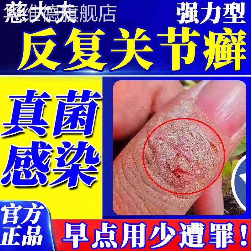 手指关节癣手癣脱皮干 干裂真菌感染湿疹手足硬皮止痒药监备案药