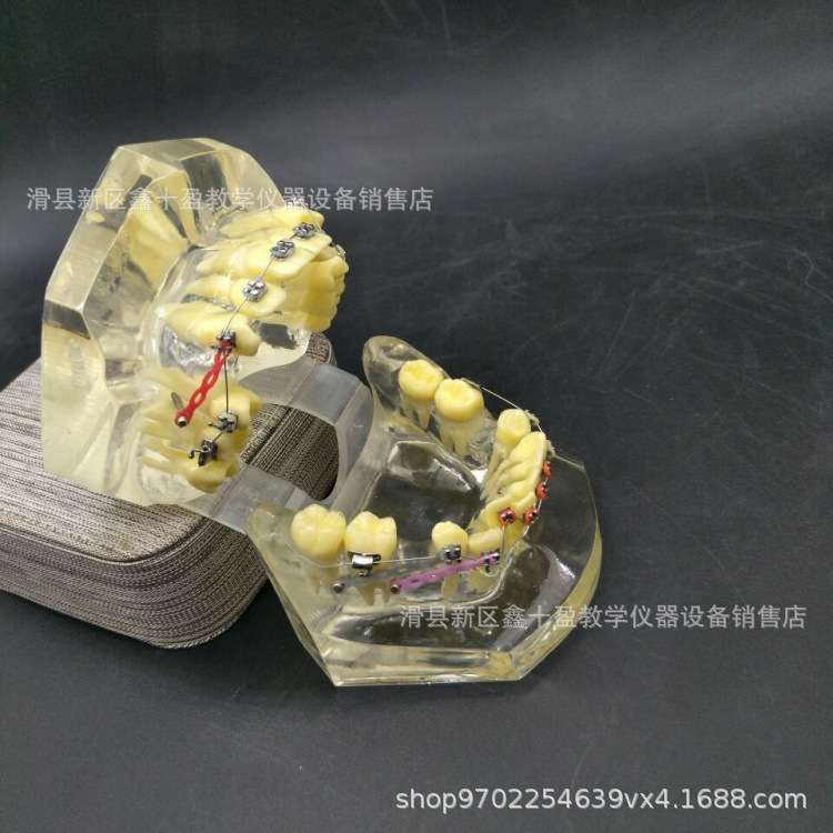正畸模型 错颌矫正牙齿示范 牙列不齐拥挤缺失伸长展示 带支抗钉