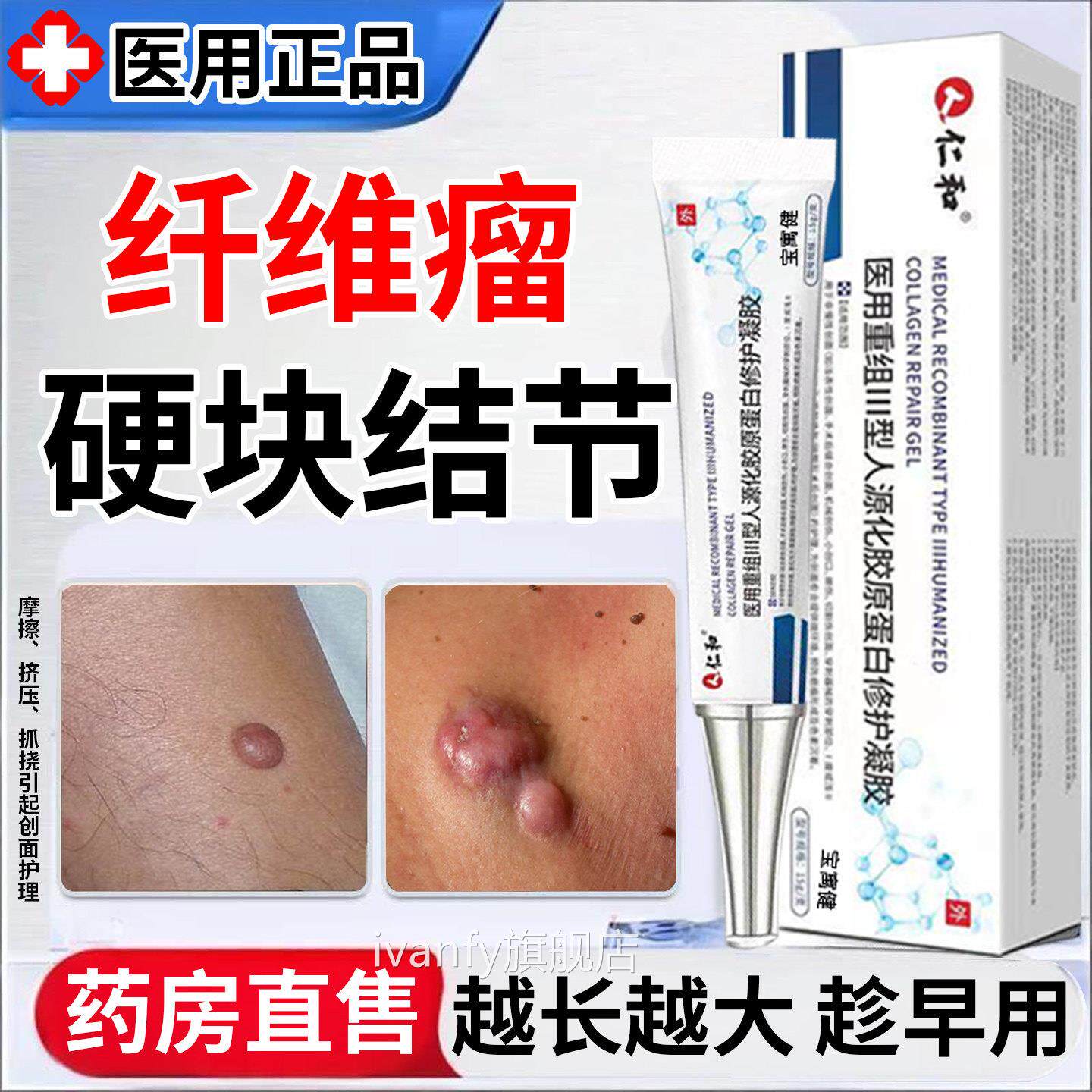 皮肤纤维瘤去除药膏皮下肿硬块鼓包脂肪瘤化瘤结节消瘤效皮脂特腺