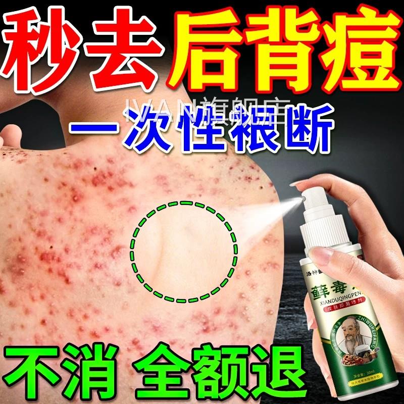 后背祛痘喷雾去除前胸背上痘痘虫毛囊炎疙瘩痤疮止螨痒效特喷剂药