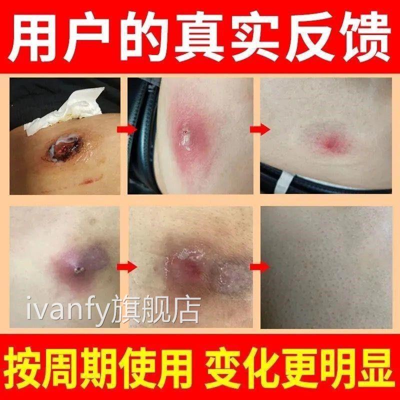 拔膏拔毒贴吸脓头屁股火疖子硬块毒脓包痘坐板疮拔脓膏吸浓贴神器
