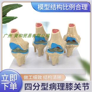 四分型膝关节正常与膝盖骨病变组合模型 病态膝关节骨骼 人体模型