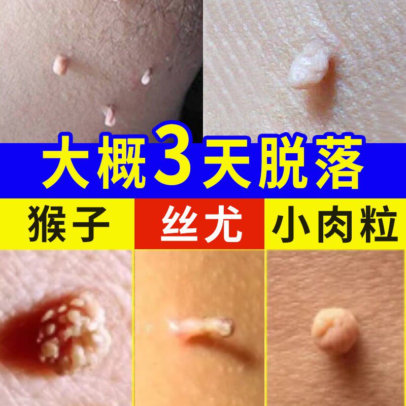 去尤小疙瘩去脖子上脸上胳肢窝猴子一抹无忧皮赘神器膏除