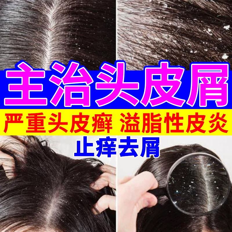 去头屑酮康唑洗剂正品头皮糠疹治头皮屑头屑严重止痒脂溢性皮炎