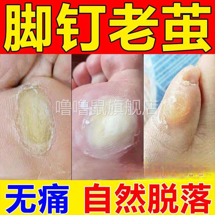 噜噜鼠正品〔实体店同款〕茧净茧护理抗菌液去老茧脚茧神器去除鸡