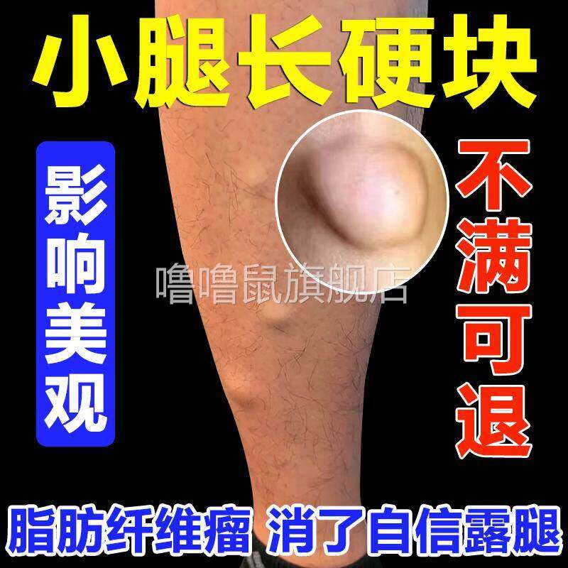 噜噜鼠正品皮肤下脂肪纤维瘤小腿硬块疙瘩囊肿治去除疗软包散结消