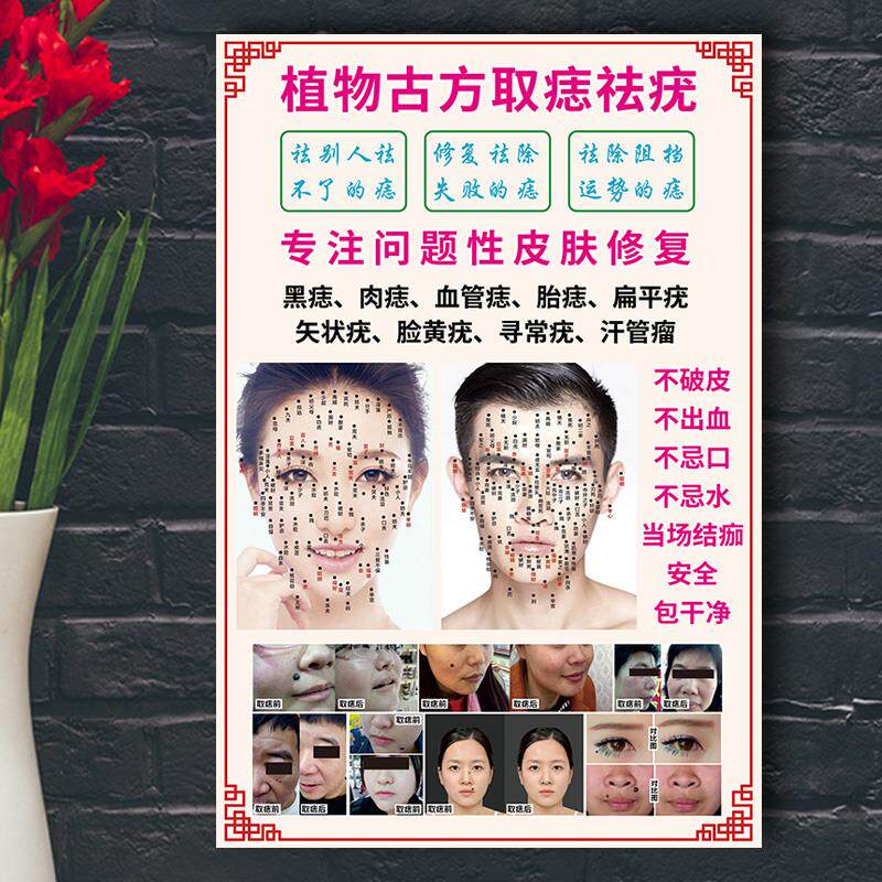 点痣宣传图片美容院面部美容祛痣祛疣祛斑广告图面痣图解海报贴纸