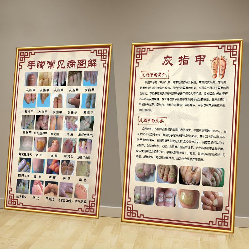 手脚常见病挂图足疗海报修脚装饰画足部墙贴脚气宣传画灰指甲挂画