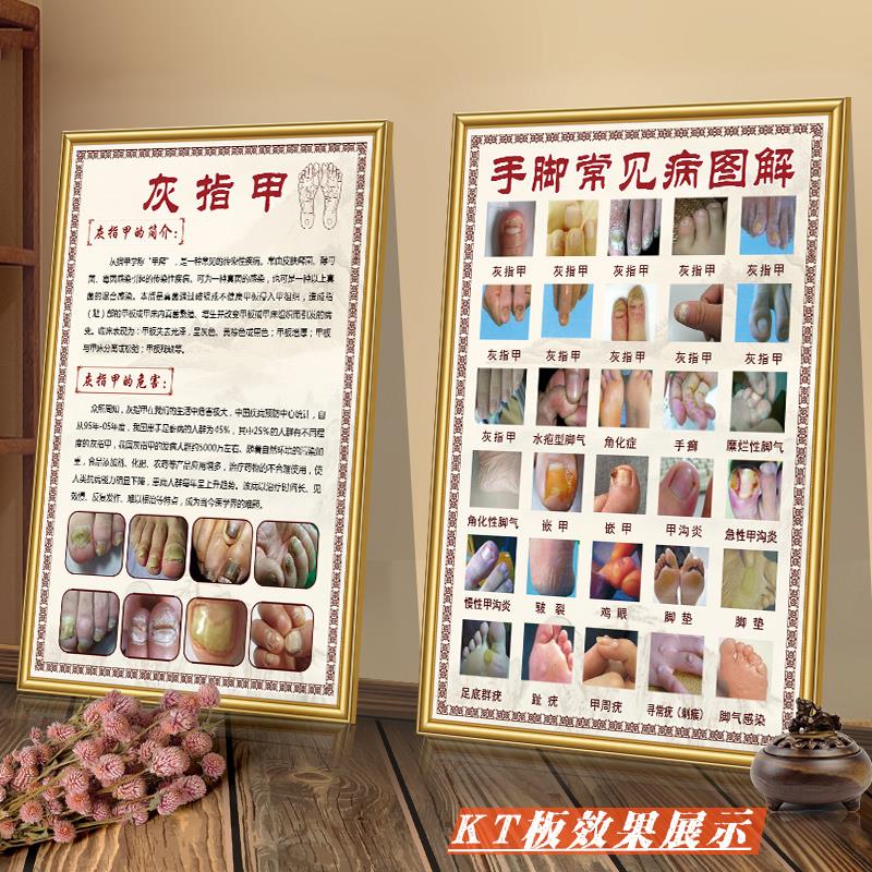 手脚常见病挂图足疗海报修脚装饰画足部墙贴脚气宣传画灰指甲挂w
