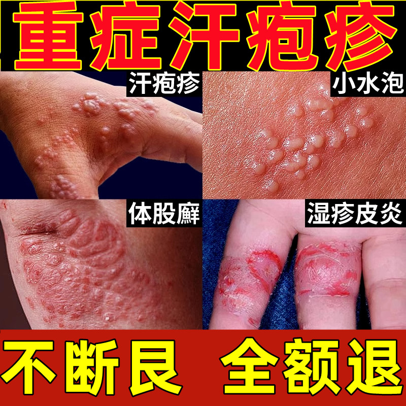 汗泡疱疹专用软膏手上起小水泡干裂手痒脱皮汗状真菌感染手气药膏