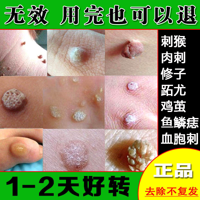 祛刺猴去除正品鱼鳞痣手足部肉刺膏点治候手猴子神跖又血胞刺灵净