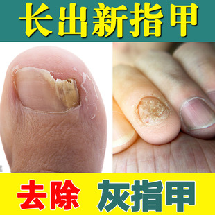 无痛灰指甲专用膏油正品 去除灰指甲脚趾甲冰醋酸療水抑菌植素本灵