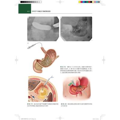 ERCP内镜逆行胰胆管造影