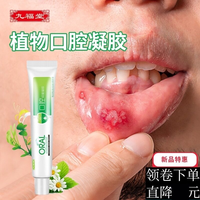 口疮口腔凝胶喷剂贴日本一点灵性舌头嘴巴上火起泡烂儿童