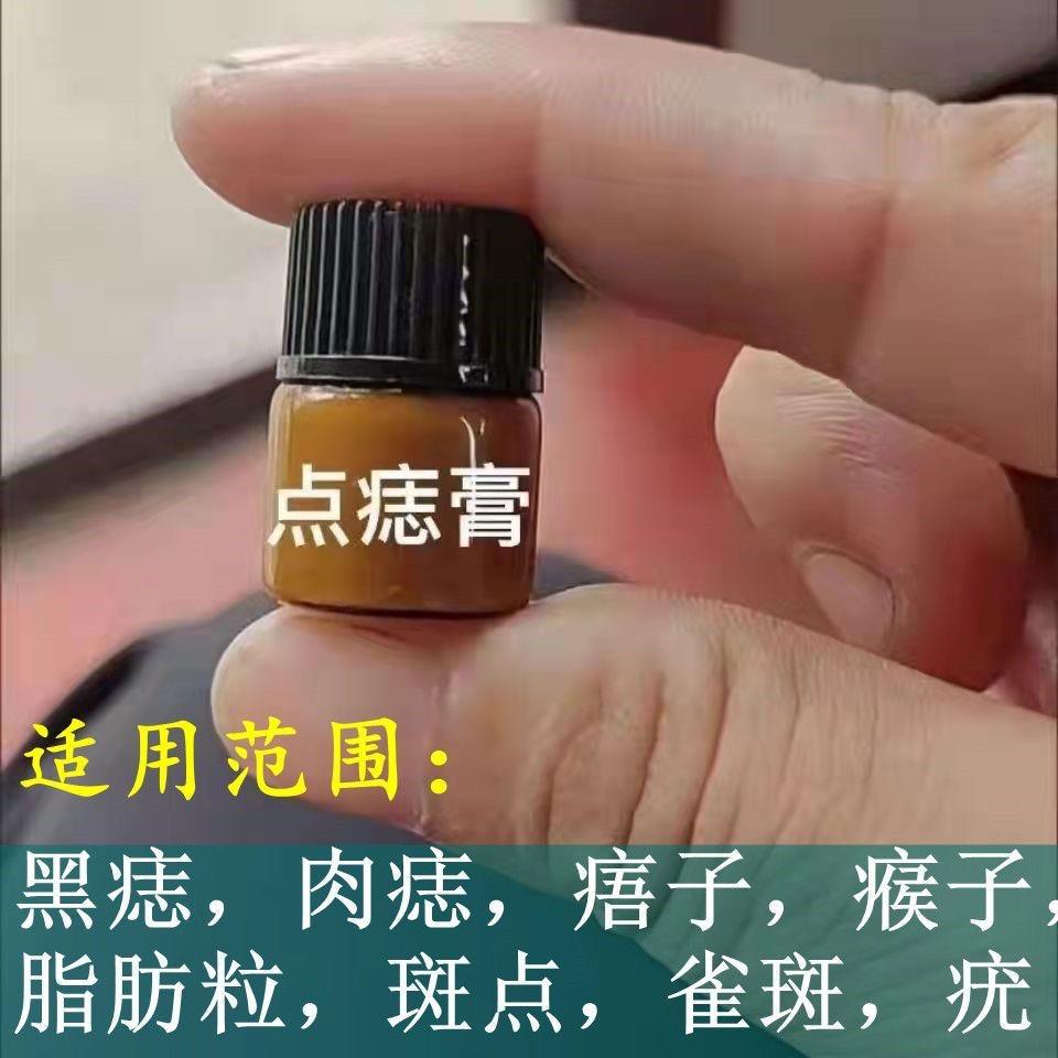 点痣膏无痕正品脸部点痦子取痣去黑痣专用点痣药水神器仪去除黑点