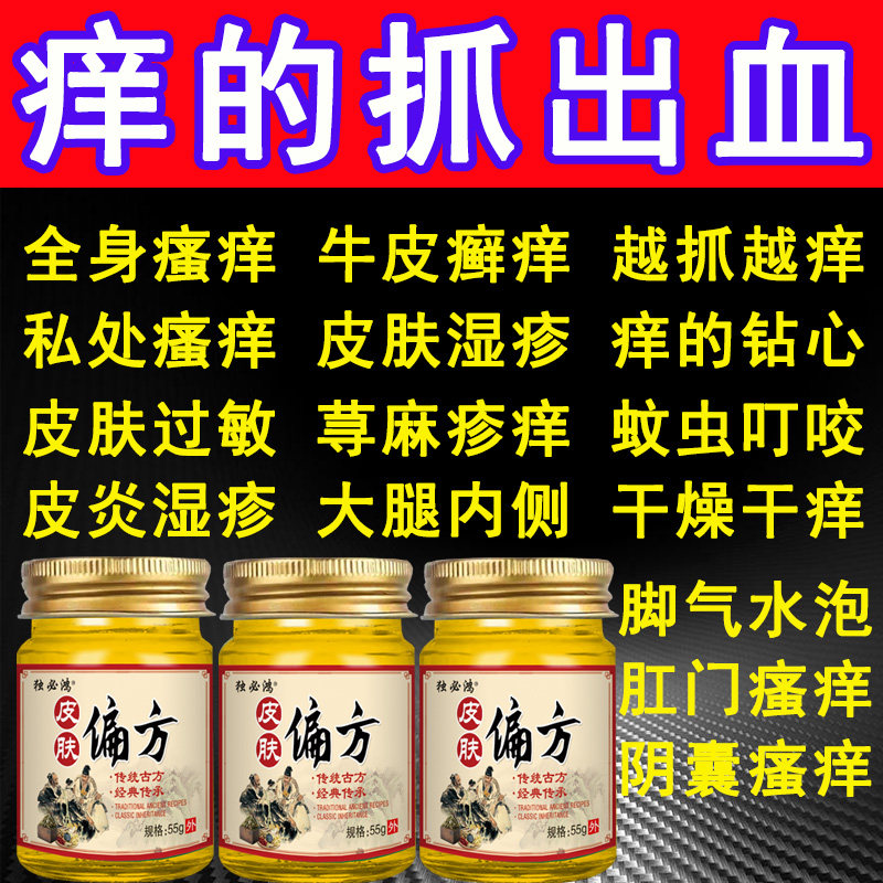 治疗牛皮藓癣银屑病专用老偏方无激素头皮癣去湿疹止痒根特效药膏