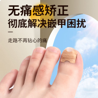?正甲貼甲溝嵌甲矯正?腳指甲