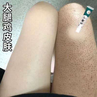 去鸡皮肤疙瘩毛囊角化角质药膏去除全身手臂腿鸡皮疙瘩磨砂乳膏a