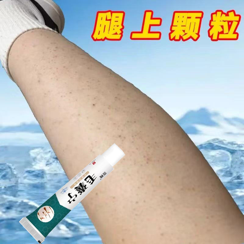 去鸡皮肤疙瘩毛囊角化角质药膏去除全身手臂腿鸡皮疙瘩磨砂乳膏t