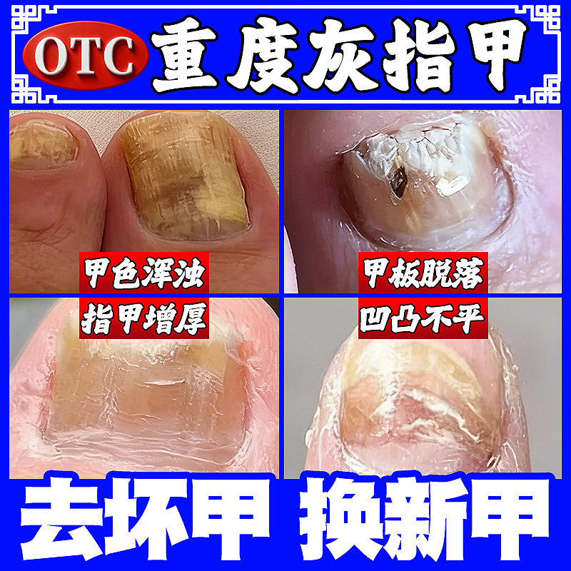 盐酸特比萘芬乳膏正品治疗灰指甲专用药去旗舰店第治非特效一名NN