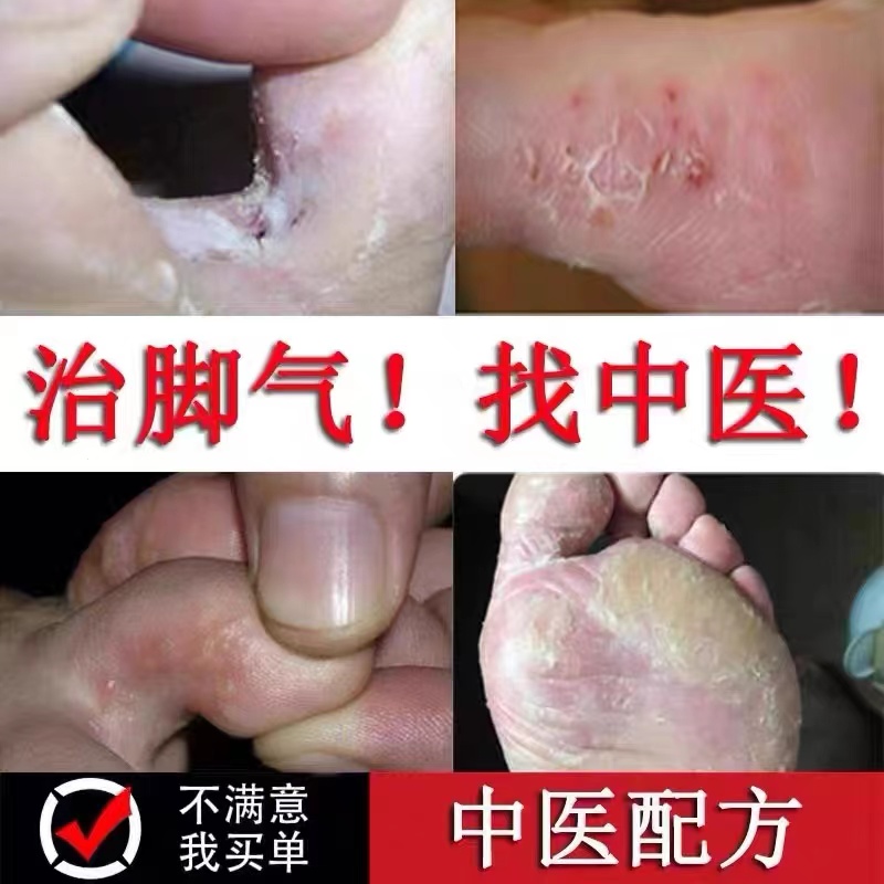 治疗脚气癣止痒脱皮杀菌药膏喷剂手足藓去臭烂脚丫根神器真菌感染