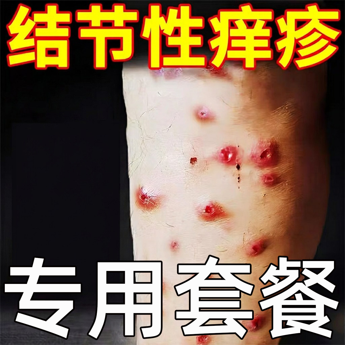 结节性痒疹顽固小腿硬疙瘩成人四保健理疗