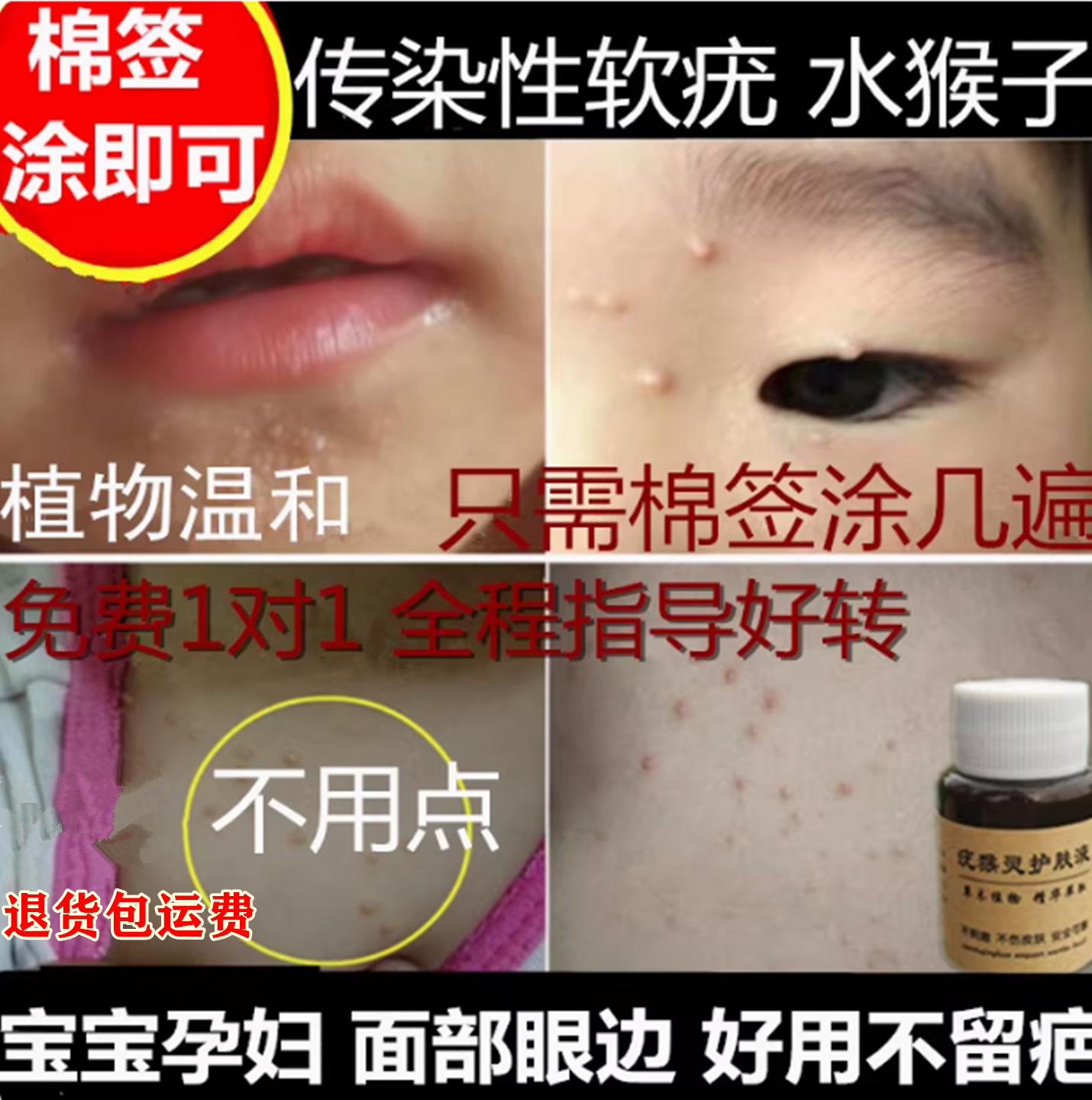不疼 面部传染性软疣儿童水猴子宝宝水瘊子病毒性软疣刮勺软尤膏