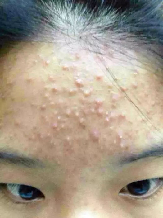 草本闭口粉刺去痘水额头下巴痘坑痘印男女青春痘学生祛痘克星定制