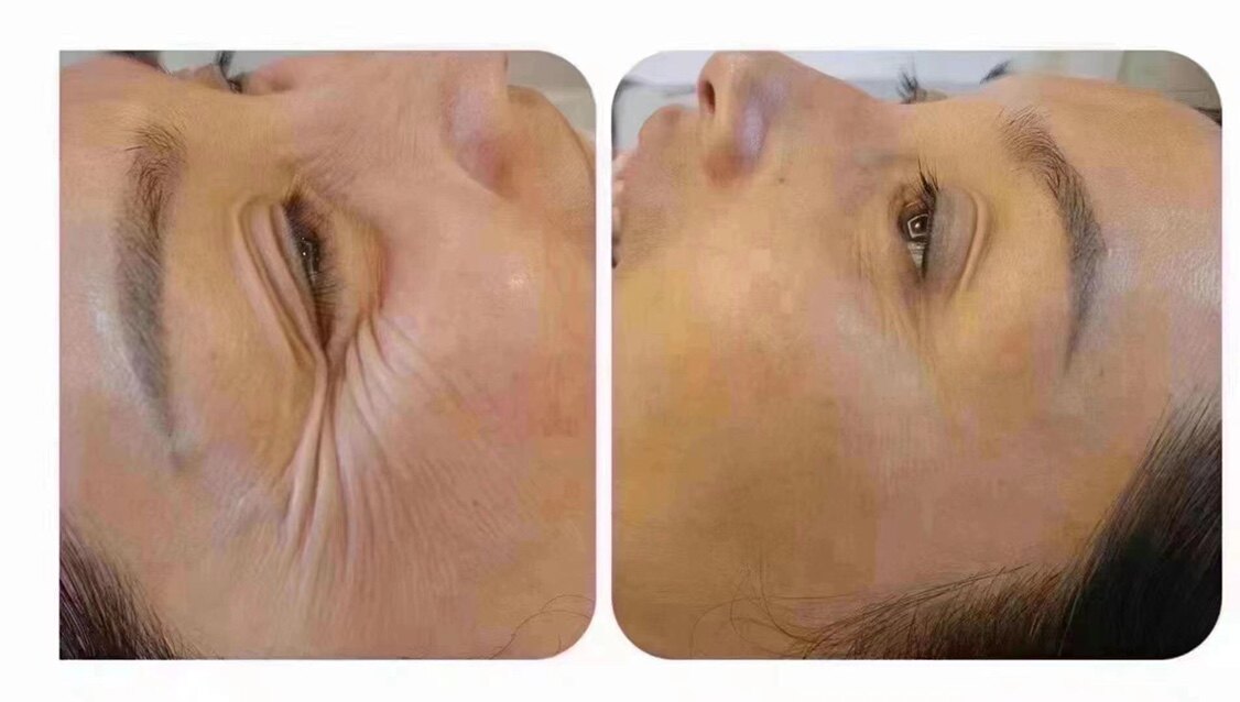 特价!除皱 全脸除皱 只限北京地区!法令纹鱼尾纹川字纹抬头纹