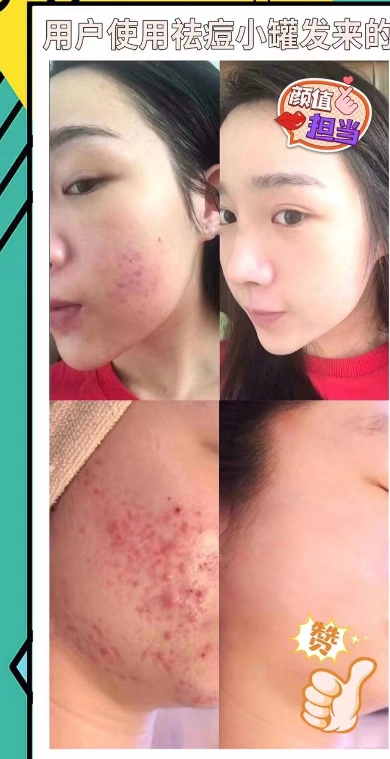 痘痘,痤疮,粉刺,闭口,脓包,痘坑印痘痘精华液30克痘痘霜30克