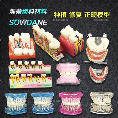 牙科模型种植正畸讲解医患沟通