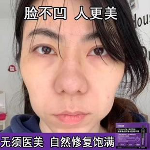 修复法令纹泪沟太阳穴脸颊额头凹陷提拉紧致敏感肌可用官方正品