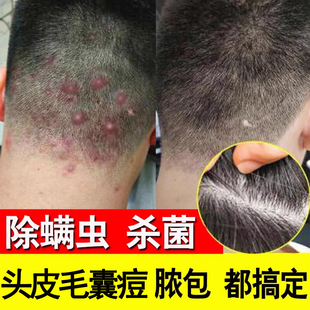 【仁和匠心】毛囊清洁洗发水头部炎二硫化硒控油止头痒洗发露正品