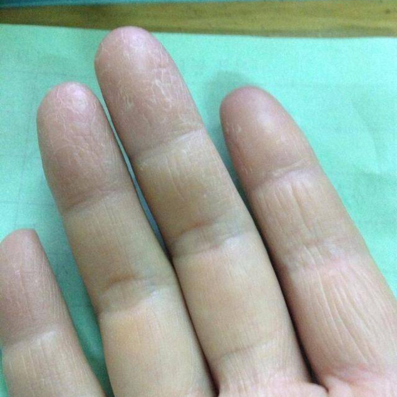 宝妈推荐儿童手脱皮专用膏手指掉皮成人脚底爆皮退皮起皮蜕皮手心
