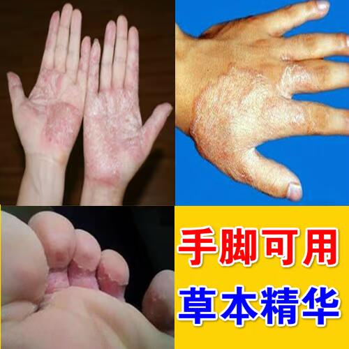 手痒起泡脱皮干裂手上起小泡泡脱皮膏手气手掌起皮干燥季节性红点