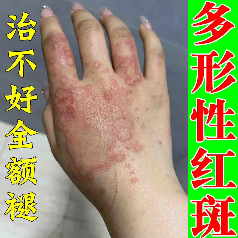 多形性红斑正品软膏治皮肤过敏红斑狼疮手背出现大量红斑红斑狼疮