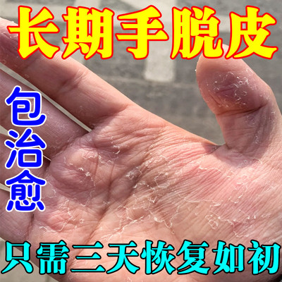 手严重脱皮专用真菌蜕皮干燥起皮干裂季节性脱皮手掌爆皮粗糙秋冬