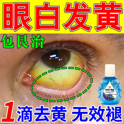 眼白发黄清澈去黄眼睛红血丝干涩痒修复眼底黄斑病变异物感眼药水