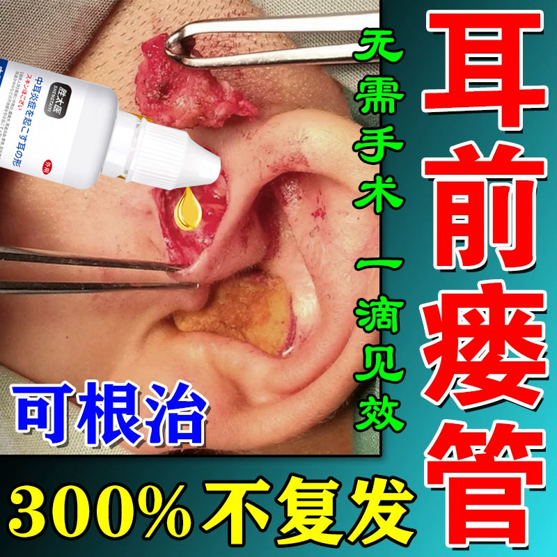 中耳炎专用药可除根滴耳液耳聋左慈丸聋耳鸣嗡嗡响药根膏滴耳油液