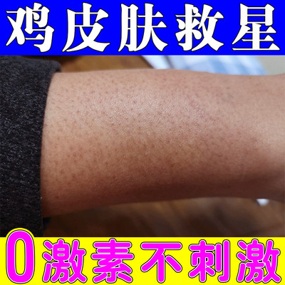 鸡皮肤去除神器皮肤疙瘩毛囊角化粗糙身上长小红点黑点痘痘修护霜