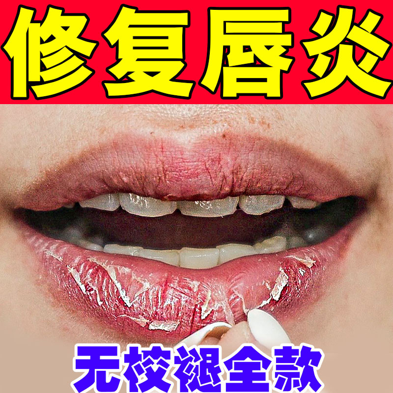 唇炎专用唇膏嘴唇干裂脱皮去角质去死皮克星唇裂修复软膏