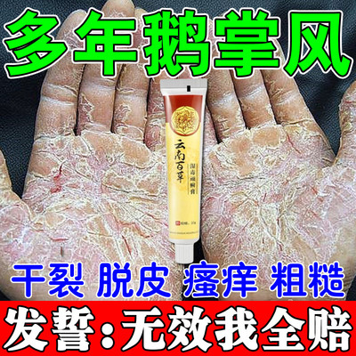 治疗手癣鹅掌风脱皮干裂真菌感染手足癣特效药膏手藓烂手手指开裂