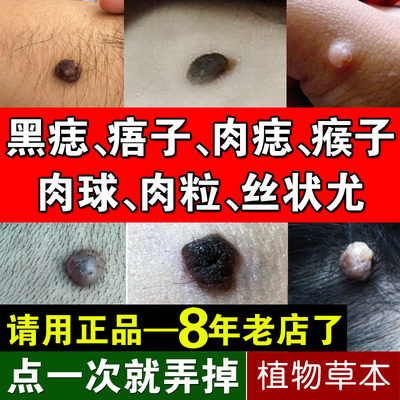 祛瘊子皮赘药手上脚猴子脖子上长的小肉粒疙瘩肉瘤去除膏肉痣神器