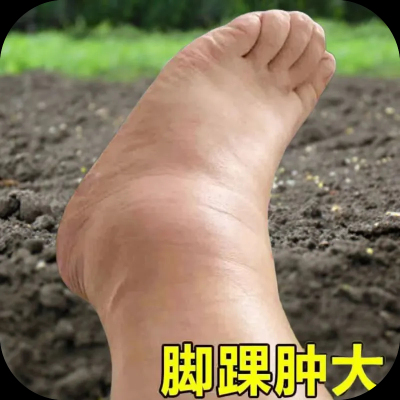 脚踝肿大疼痛专用药骨裂陈旧老伤关节肿大活血化瘀韧带拉伤药水