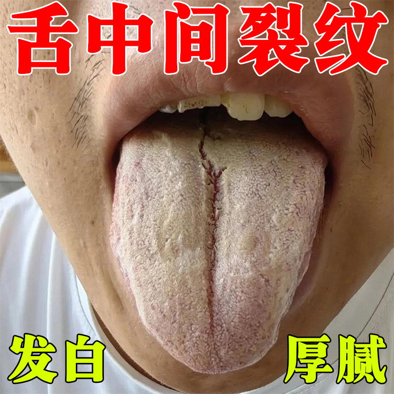 舌头中间裂纹有齿痕舌苔白厚黄腻口臭治地图舌口干口苦口气重专用