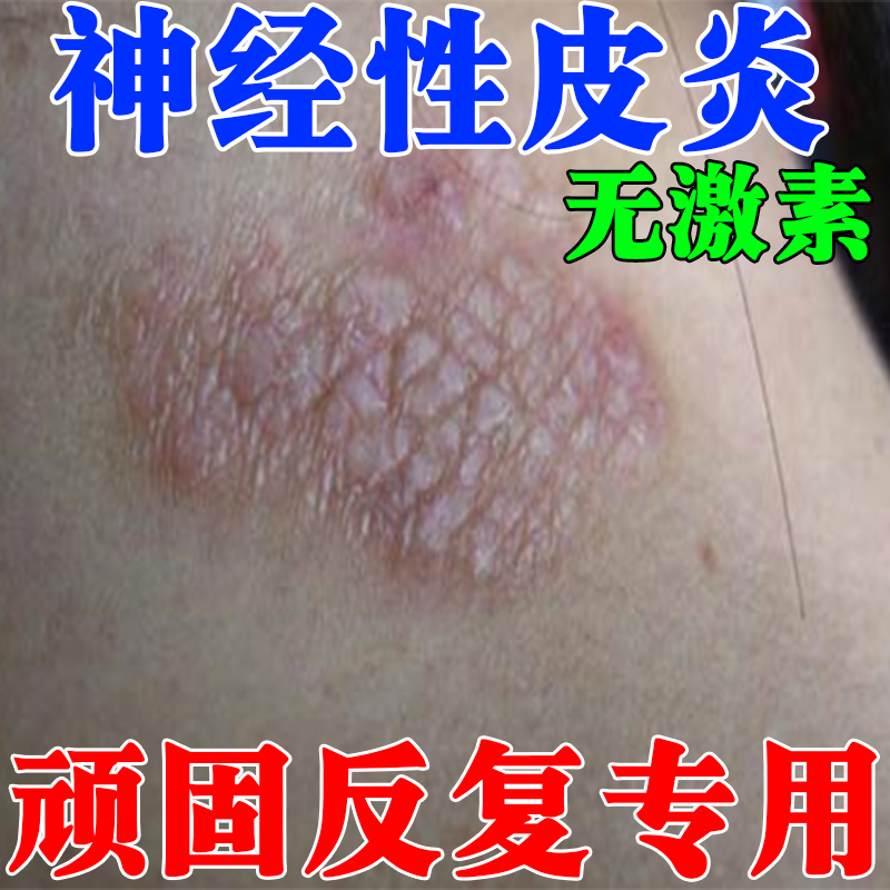 顽固神经性皮炎身上脂溢性皮炎湿痒疹皮肤过敏痒止痒膏无激素药