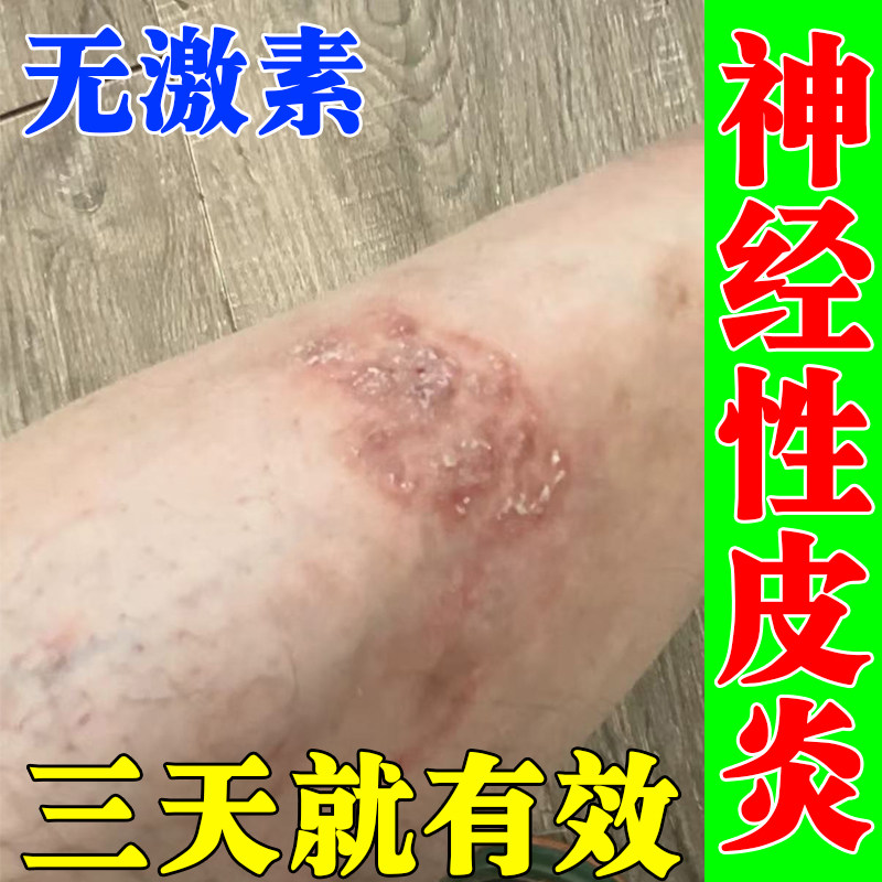顽固神经性皮炎去湿痒疹真菌感染保健理疗