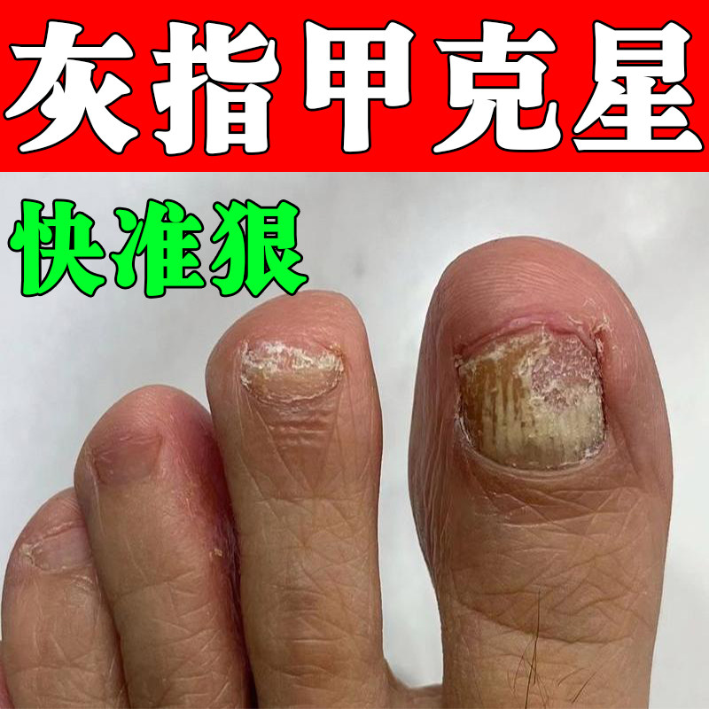 灰指甲特效抑菌液亮甲治疗手指甲脚趾甲去灰甲专用脱甲药水一滴净