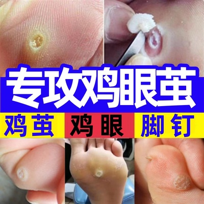 鸡眼茧膏贴刺跖疣膏瘊子鱼鳞痣休子肉刺去除膏贴甲周尤脚钉根